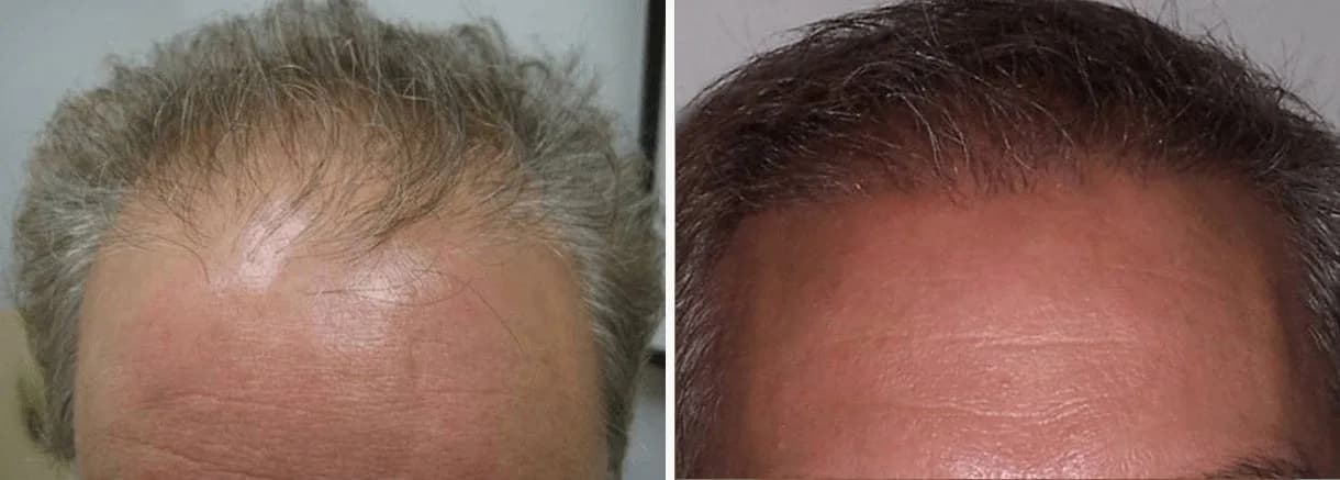 Hair restoration patient at Bubolo Medical — hairline before and after treatment, result 1