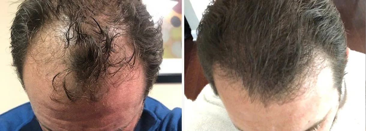 Hair restoration patient at Bubolo Medical — hairline before and after treatment, result 2