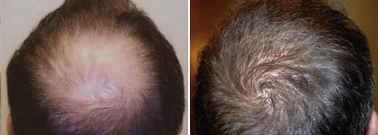 Hair restoration patient at Bubolo Medical — hairline before and after treatment, result 3