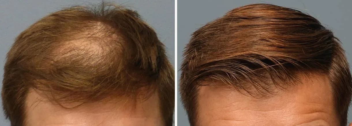 Hair restoration patient at Bubolo Medical — hairline before and after treatment, result 4