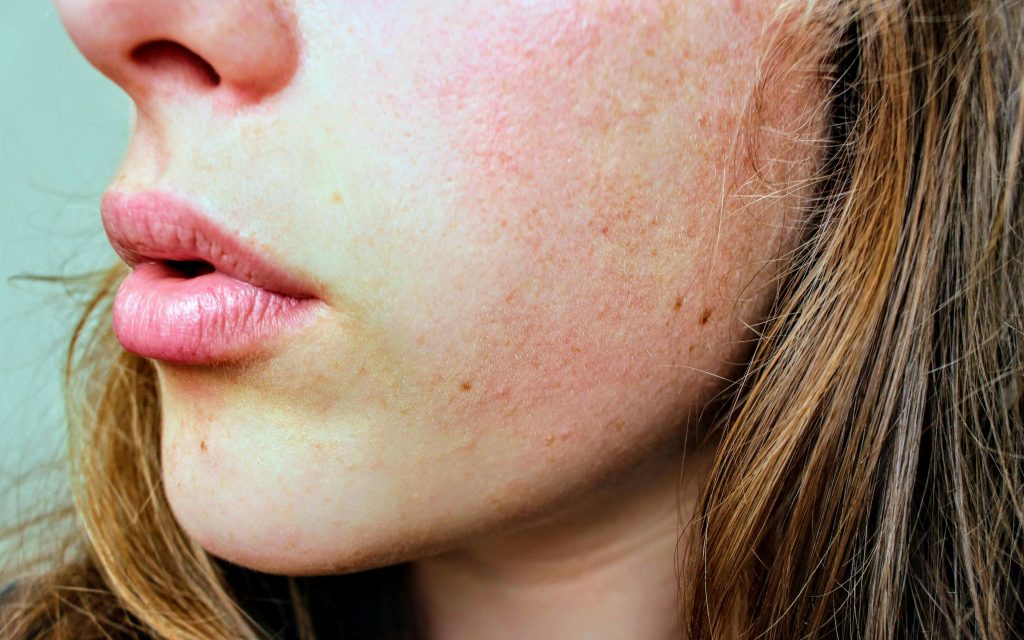 Facial pigmentation linked to hormonal changes and liver stress in women